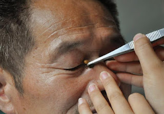 Patient Receives Bee Venom Therapy at a Chinese Hospital