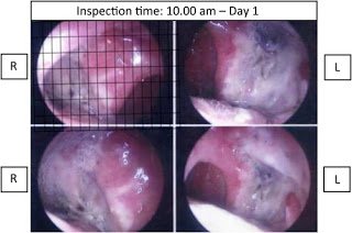 Malaysian Tualang Honey Boosts Tonsillectomy Healing Process