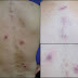 First Case of Folliculitis Associated with Granuloma as a Complication of Bee Sting Acupuncture